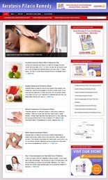 Keratosis Pilaris Niche Blog Personal Use Template With Video